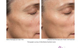 ThermaFrax Anti Aging Treatments